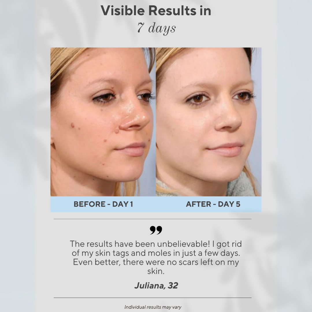 Clear Raised & Spot Blemishes at Home with ArcGuard™ Micro-Plasma Control