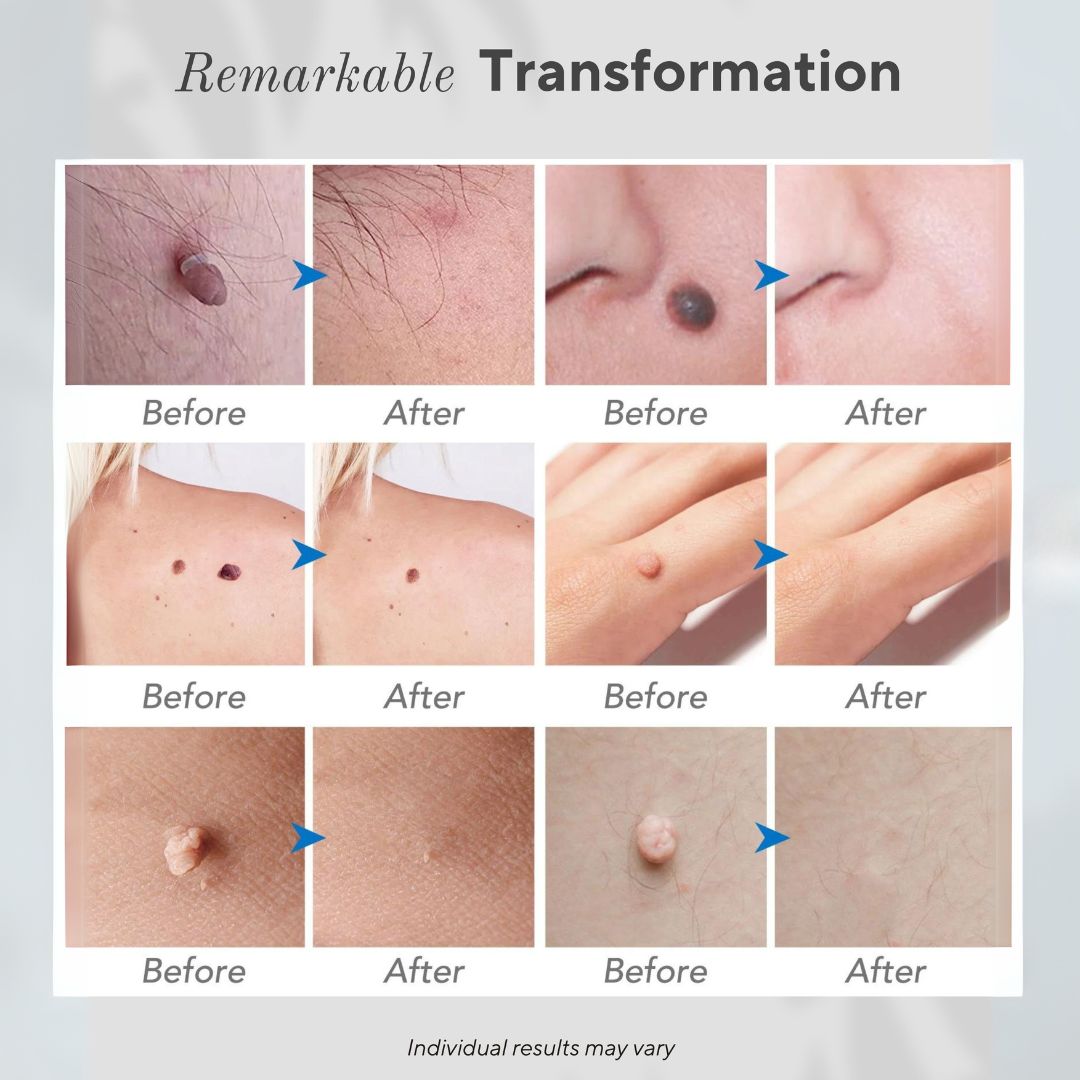 Clear Raised & Spot Blemishes at Home with ArcGuard™ Micro-Plasma Control