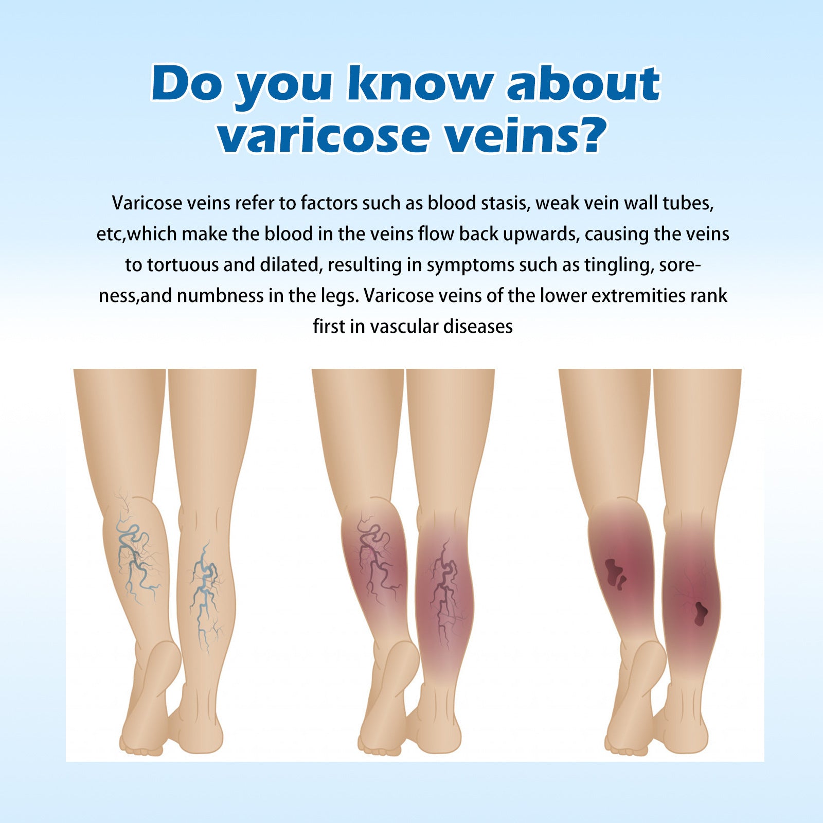 Varicose Repair Cream