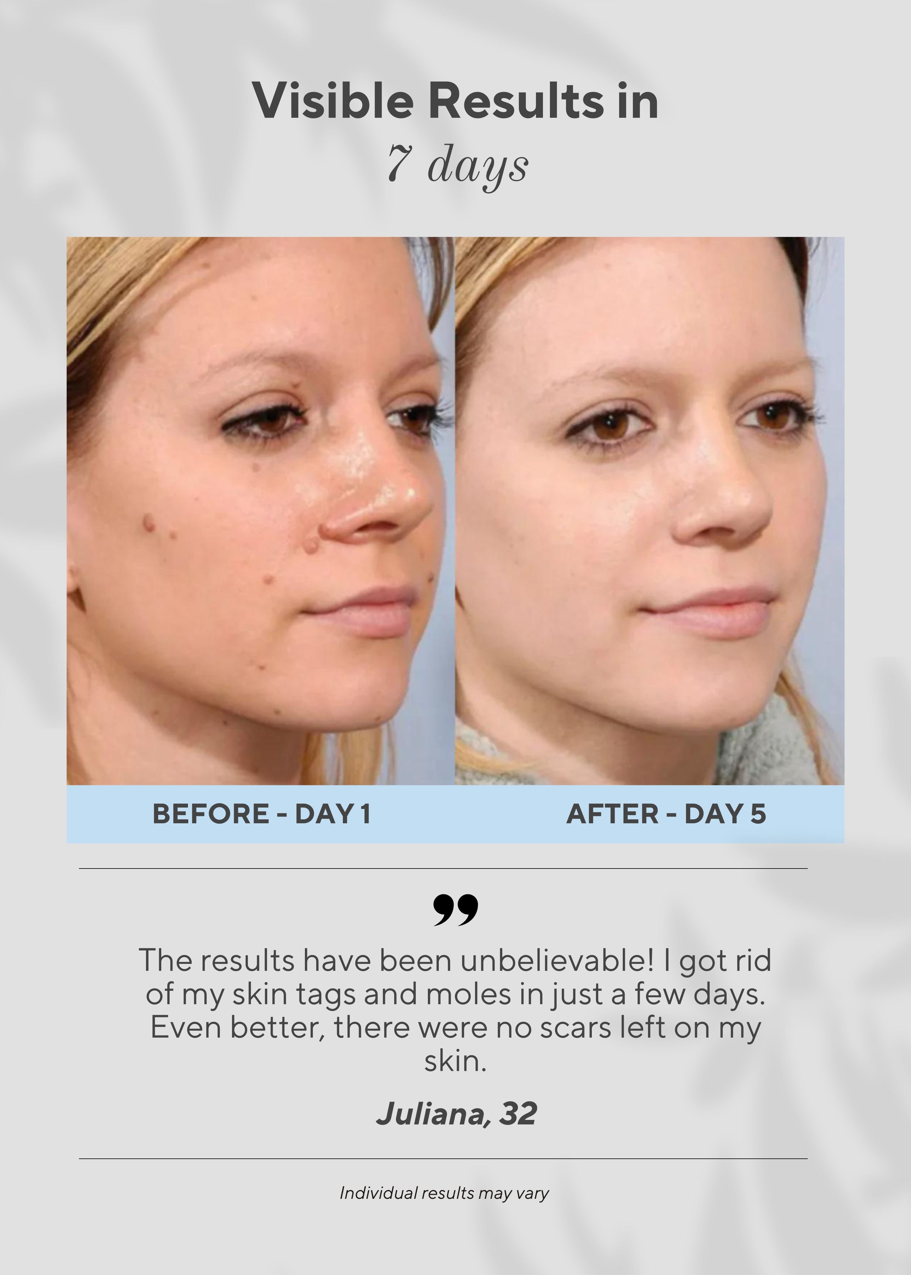 Ocura 6-in-1 plasma pen for removing skin tags, milia and dark bumps at home