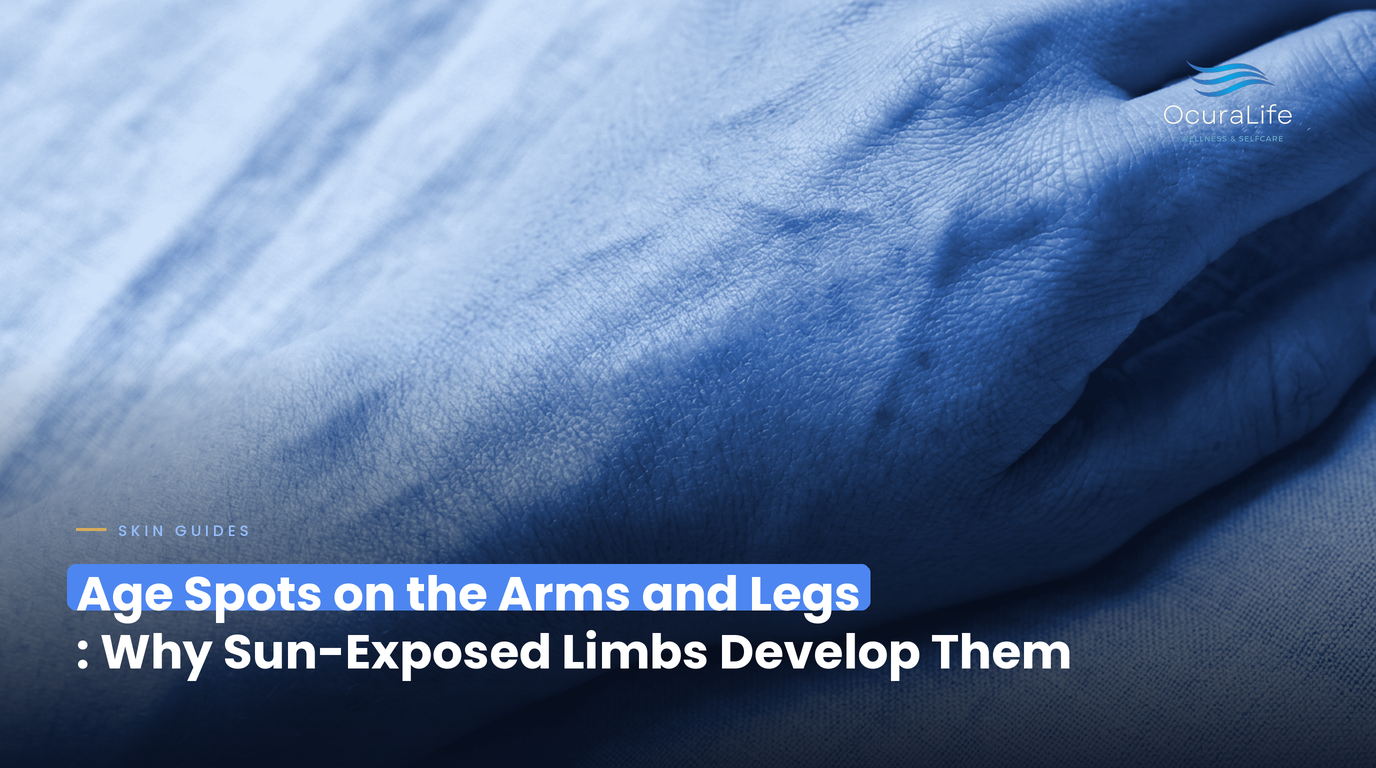 Age Spots on the Arms and Legs: Why Sun-Exposed Limbs Develop Them
