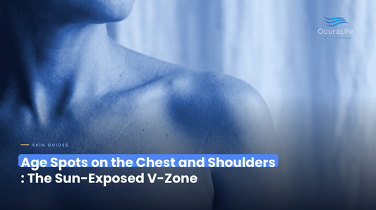 Age Spots on the Chest and Shoulders: The Sun-Exposed V-Zone