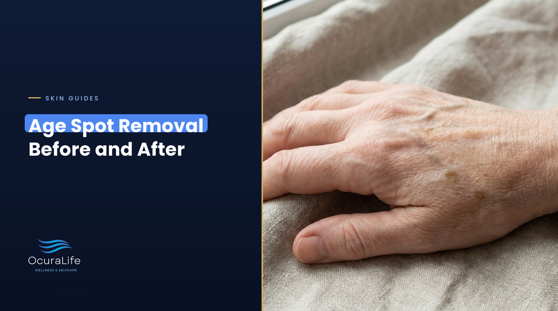 Flat brown age spots on the back of a hand, age spot removal before and after