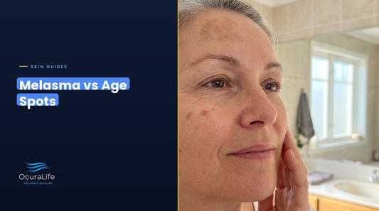 Melasma vs age spots: small round flat age spots on the cheek and a blotchy melasma patch on the forehead
