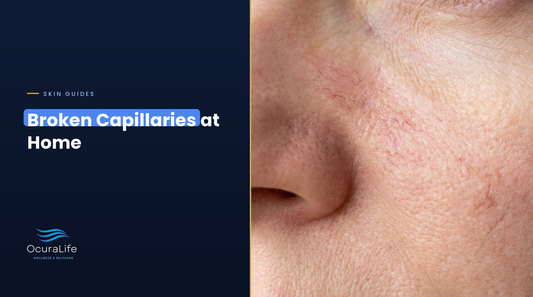 Broken capillaries at home: fine red broken capillaries beside the nose and on the cheek
