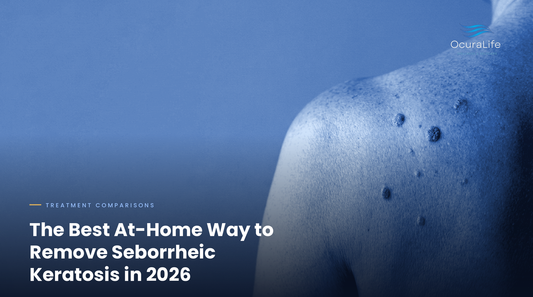The Best At-Home Way to Remove Seborrheic Keratosis in 2026