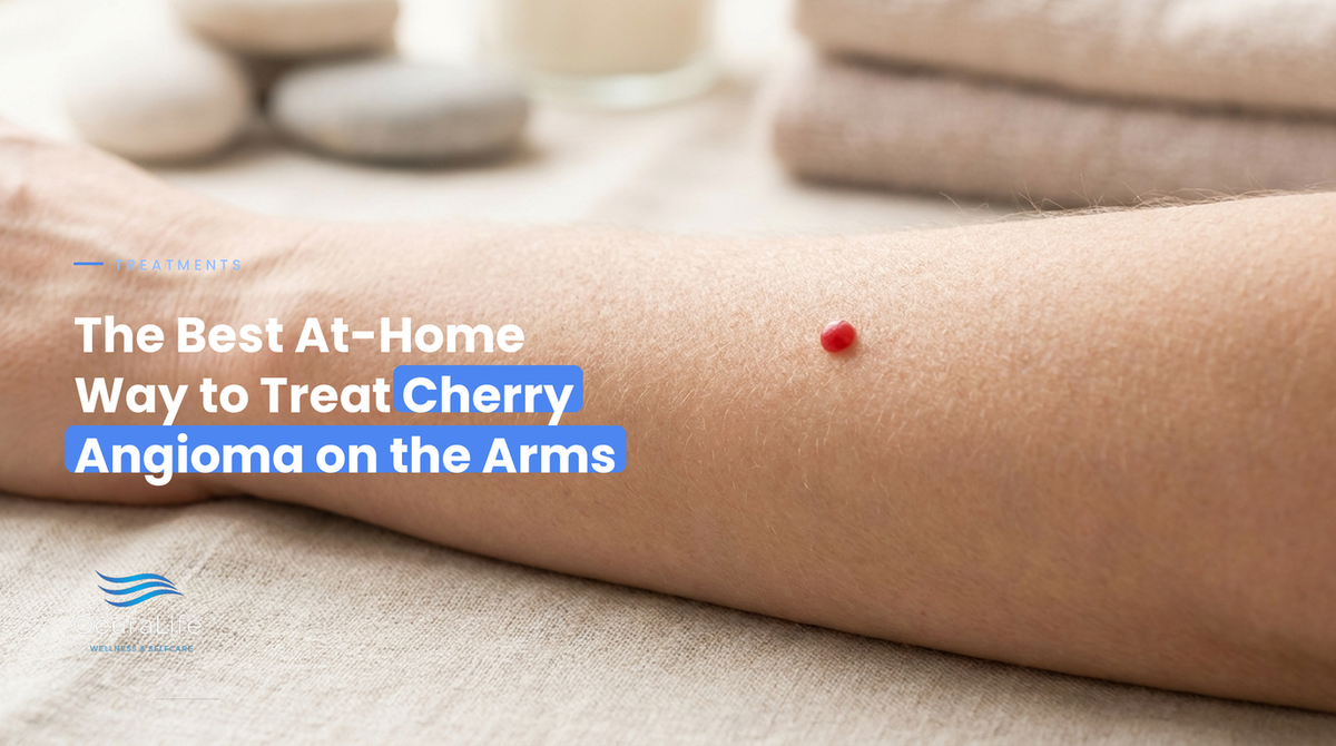 The Best At-Home Way to Treat Cherry Angioma on the Arms