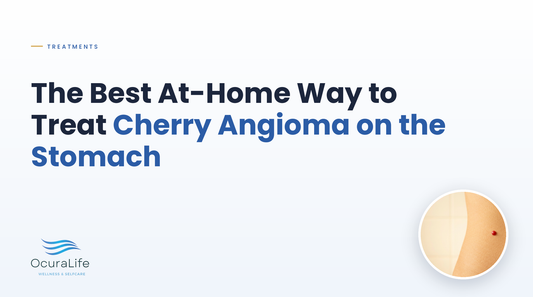The Best At-Home Way to Treat Cherry Angioma on the Stomach