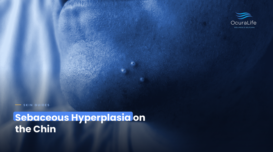 The Best At-Home Way to Treat Sebaceous Hyperplasia on the Chin