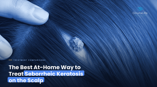 The Best At-Home Way to Treat Seborrheic Keratosis on the Scalp