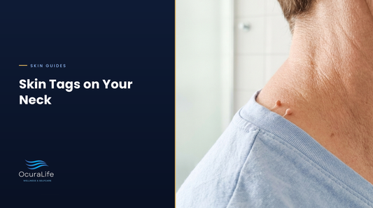 How to get rid of skin tags on your neck: small flesh-colored skin tags on thin stalks near the collar line