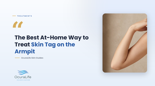 The Best At-Home Way to Treat Skin Tag on the Armpit
