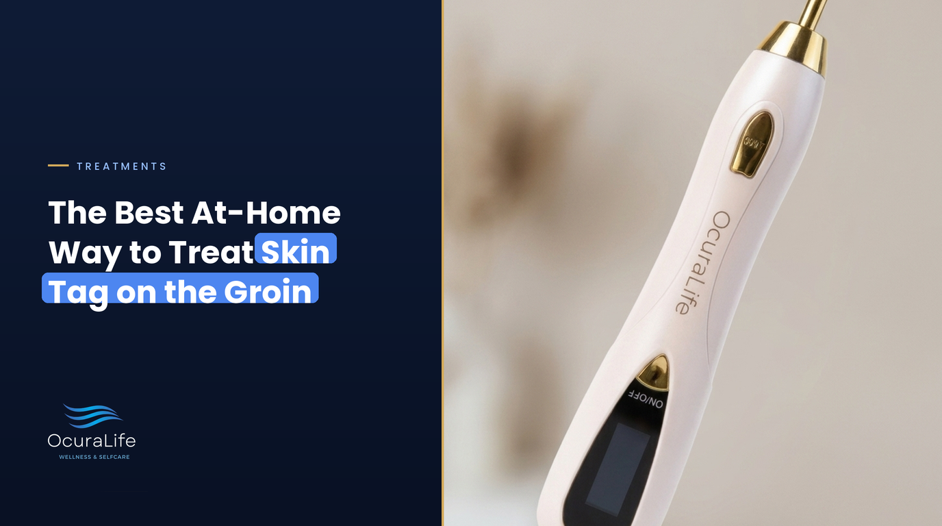 The Best At-Home Way to Treat Skin Tag on the Groin