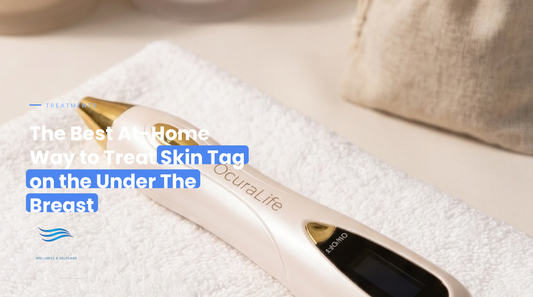 The Best At-Home Way to Treat Skin Tag on the Under The Breast