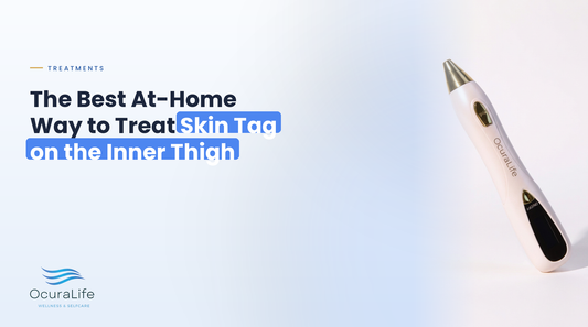 The Best At-Home Way to Treat Skin Tag on the Inner Thigh
