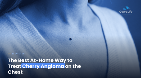 The Best At-Home Way to Treat Cherry Angioma on the Chest