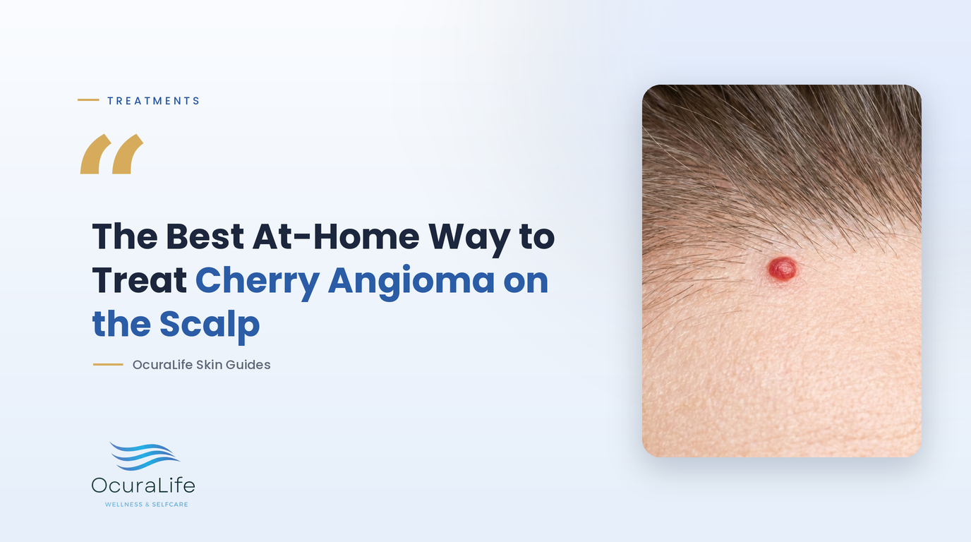 The Best At-Home Way to Treat Cherry Angioma on the Scalp