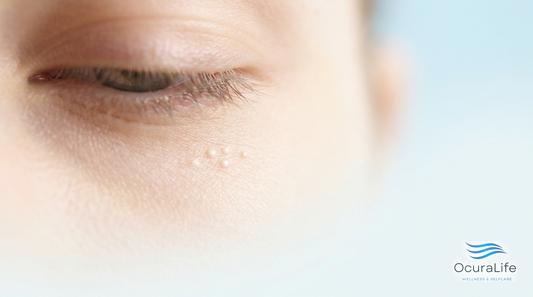 Why Milia Cluster Around the Eyes Specifically