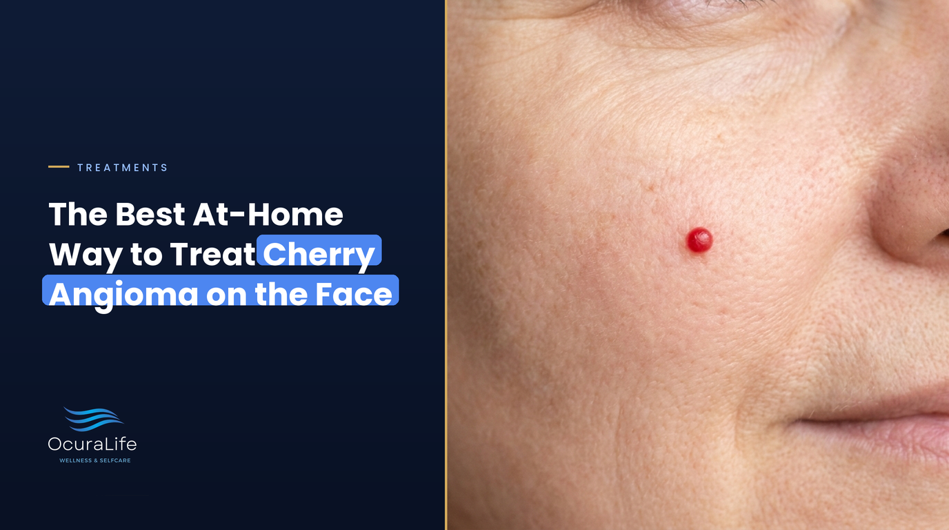 The Best At-Home Way to Treat Cherry Angioma on the Face