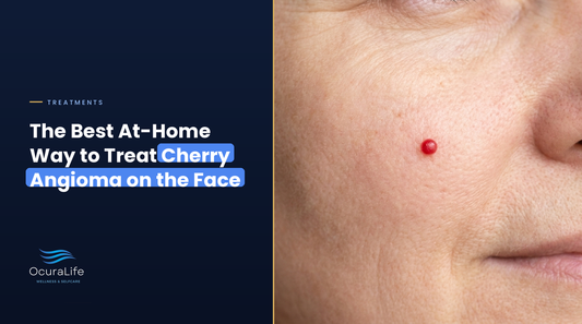 The Best At-Home Way to Treat Cherry Angioma on the Face