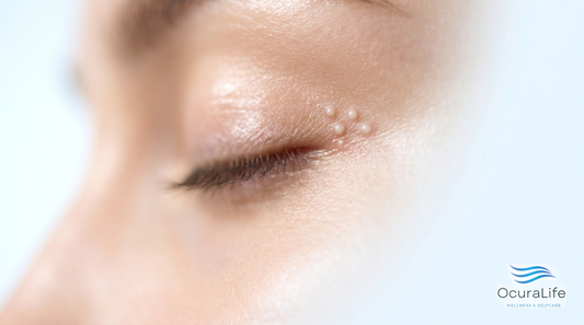 Stye vs Milia: Which Eye Bump Do You Have?
