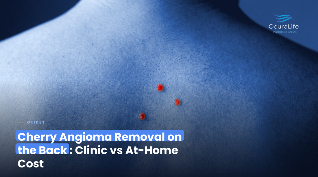 Cherry Angioma Removal on the Back: Clinic vs At-Home Cost