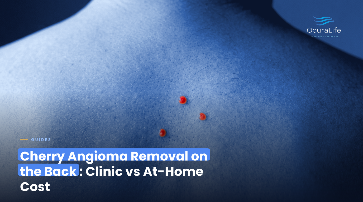 Cherry Angioma Removal on the Back: Clinic vs At-Home Cost