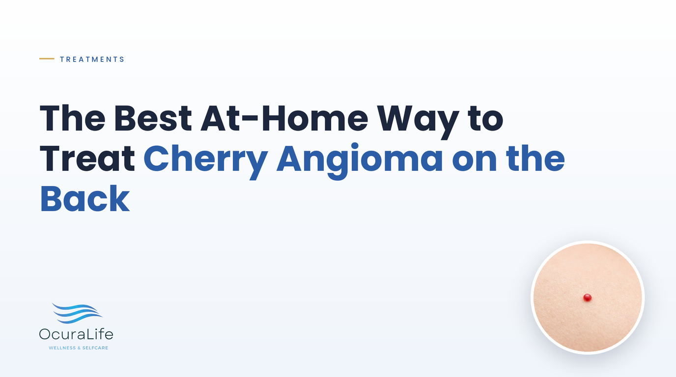 The Best At-Home Way to Treat Cherry Angioma on the Back