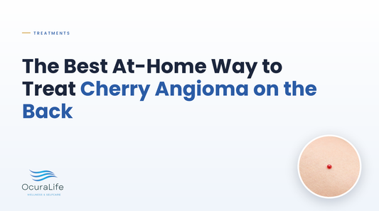 The Best At-Home Way to Treat Cherry Angioma on the Back