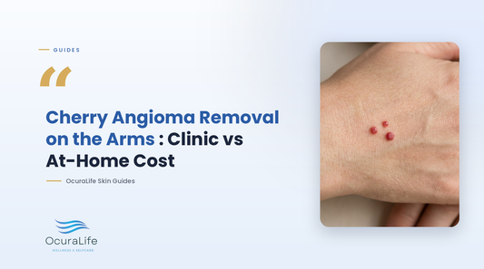 Cherry Angioma Removal on the Arms: Clinic vs At-Home Cost