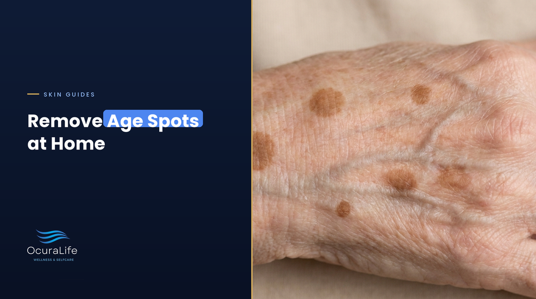 Flat brown age spots on the back of a hand, removing age spots at home