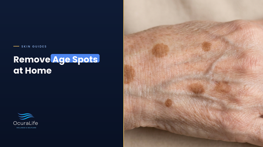 Flat brown age spots on the back of a hand, removing age spots at home