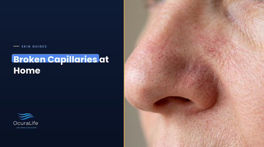 Broken capillaries on the nose and cheek: what you can do at home