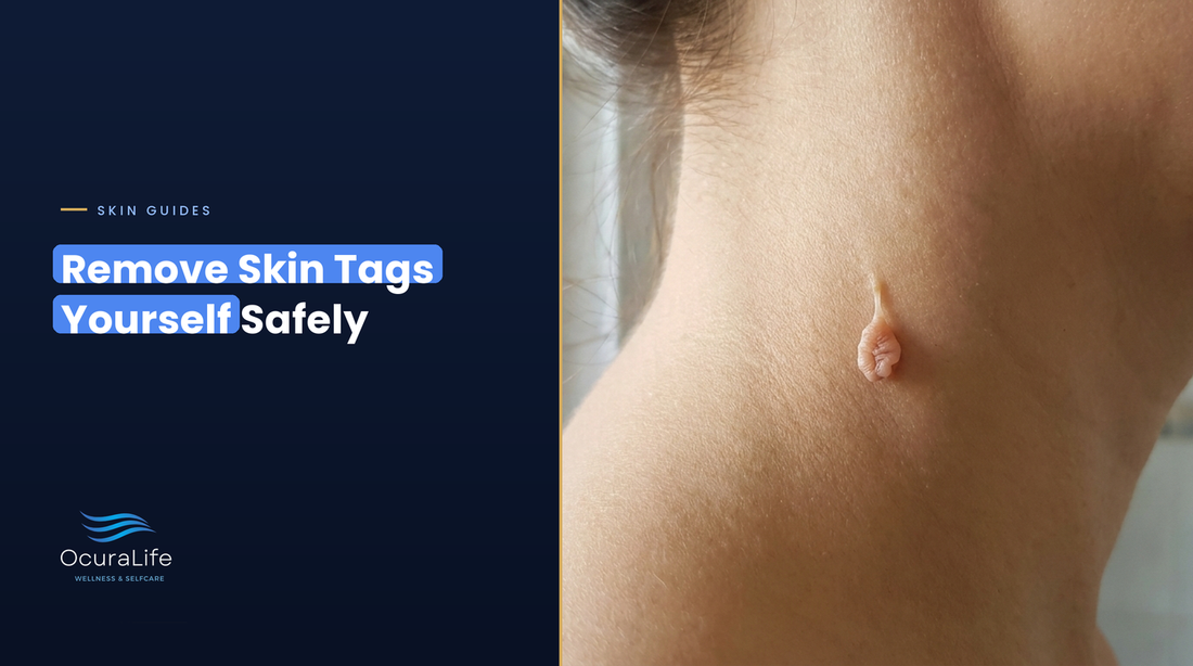Can you remove skin tags yourself safely: a soft flesh-colored skin tag on a thin stalk on the neck