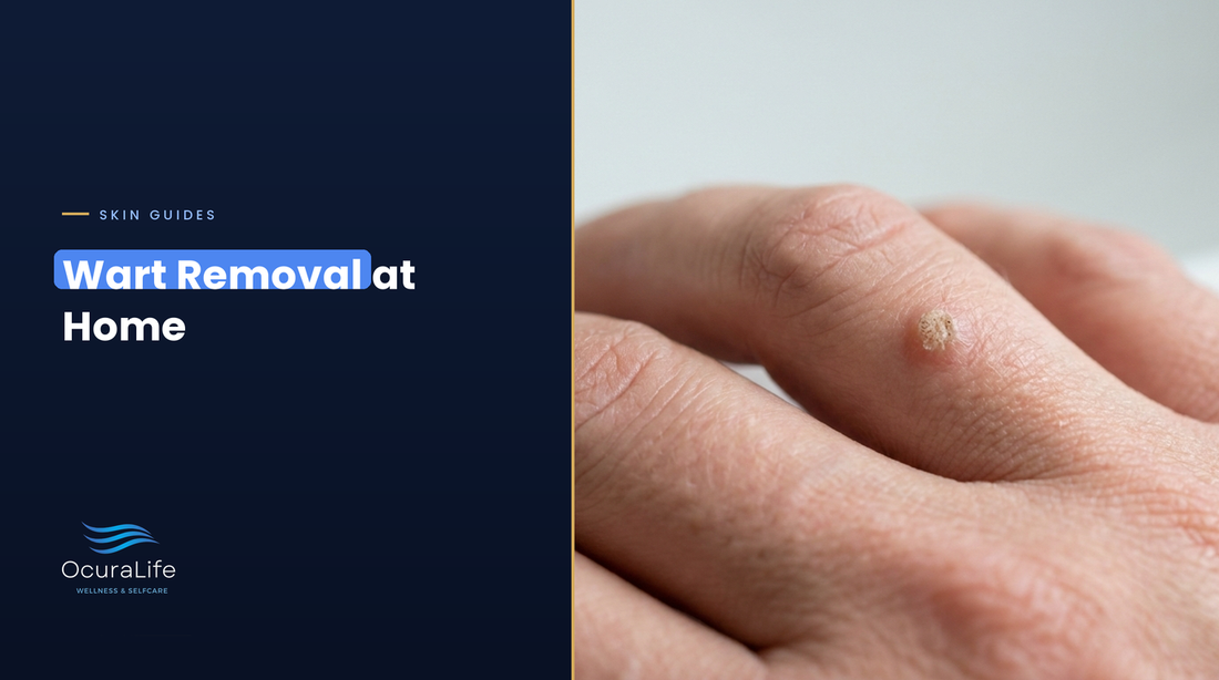 Wart removal at home: a small common wart on a finger knuckle