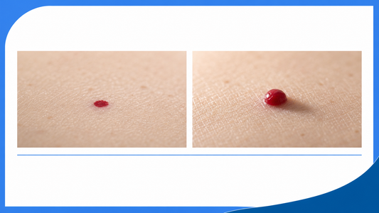 Flat vs Raised Cherry Angioma: Does It Matter? infographic