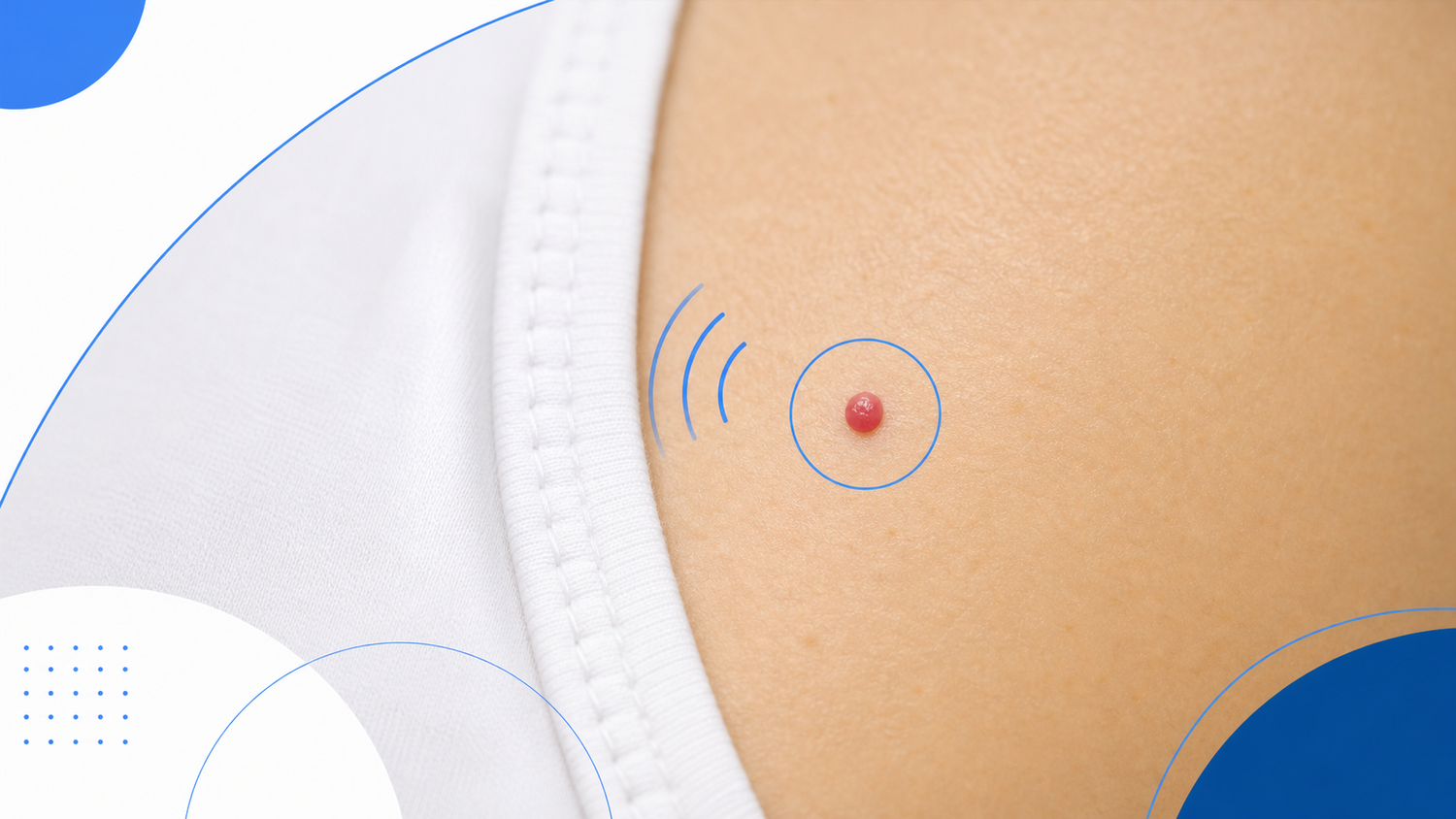 Cherry Angioma That Itches: What It Usually Means infographic