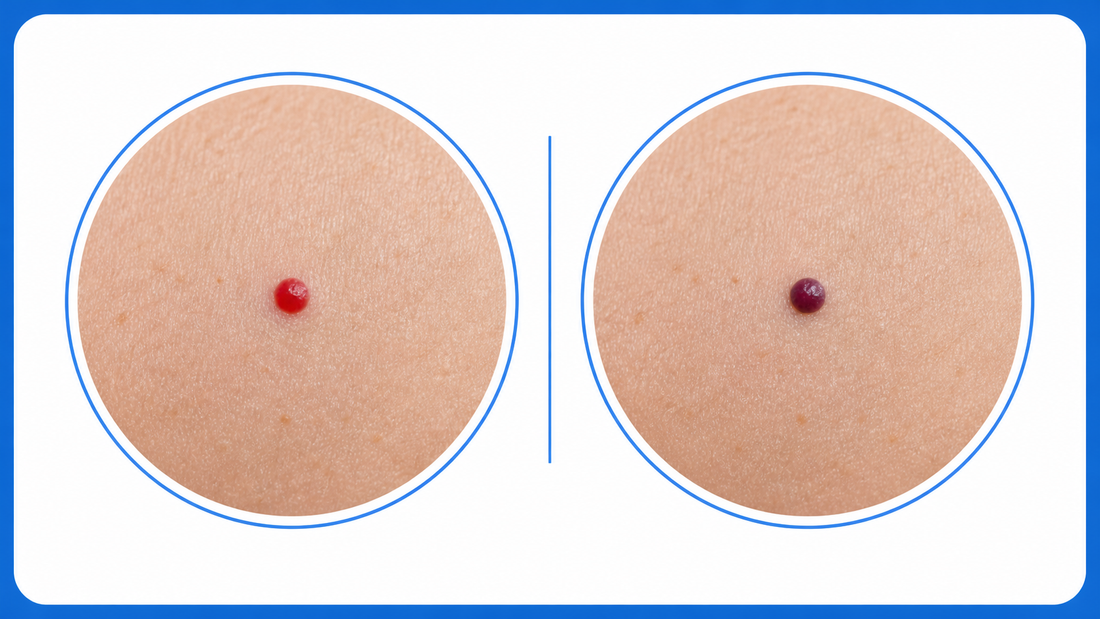 Cherry Angioma That Turned Dark or Purple infographic