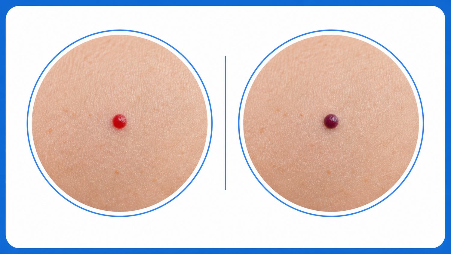 Cherry Angioma That Turned Dark or Purple infographic