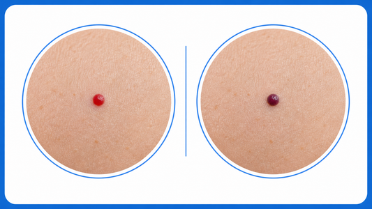 Cherry Angioma That Turned Dark or Purple infographic