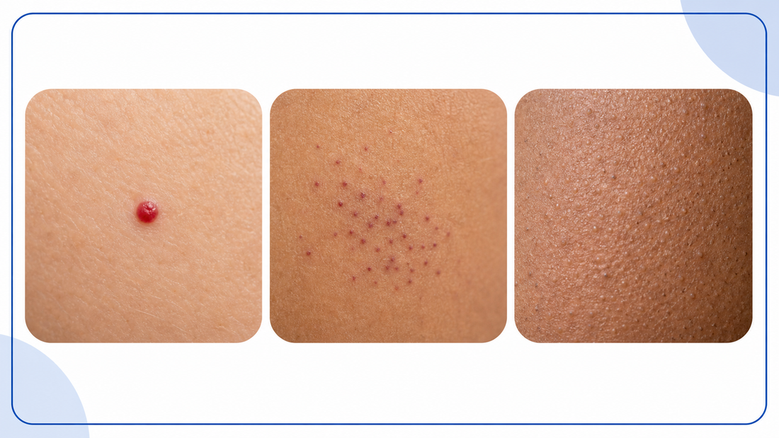 Cherry Angioma vs Petechiae vs Keratosis Pilaris infographic