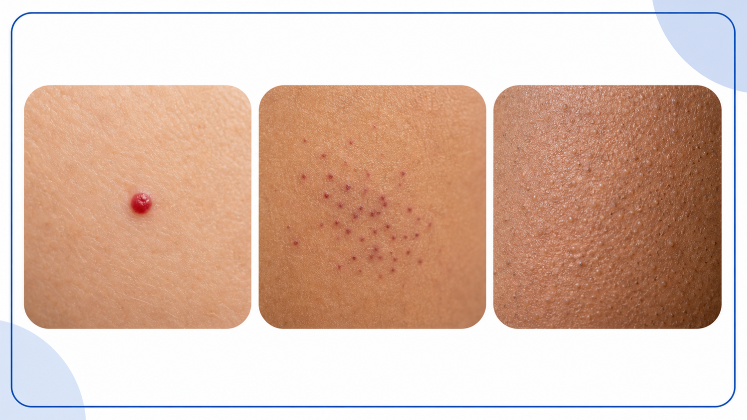 Cherry Angioma vs Petechiae vs Keratosis Pilaris infographic