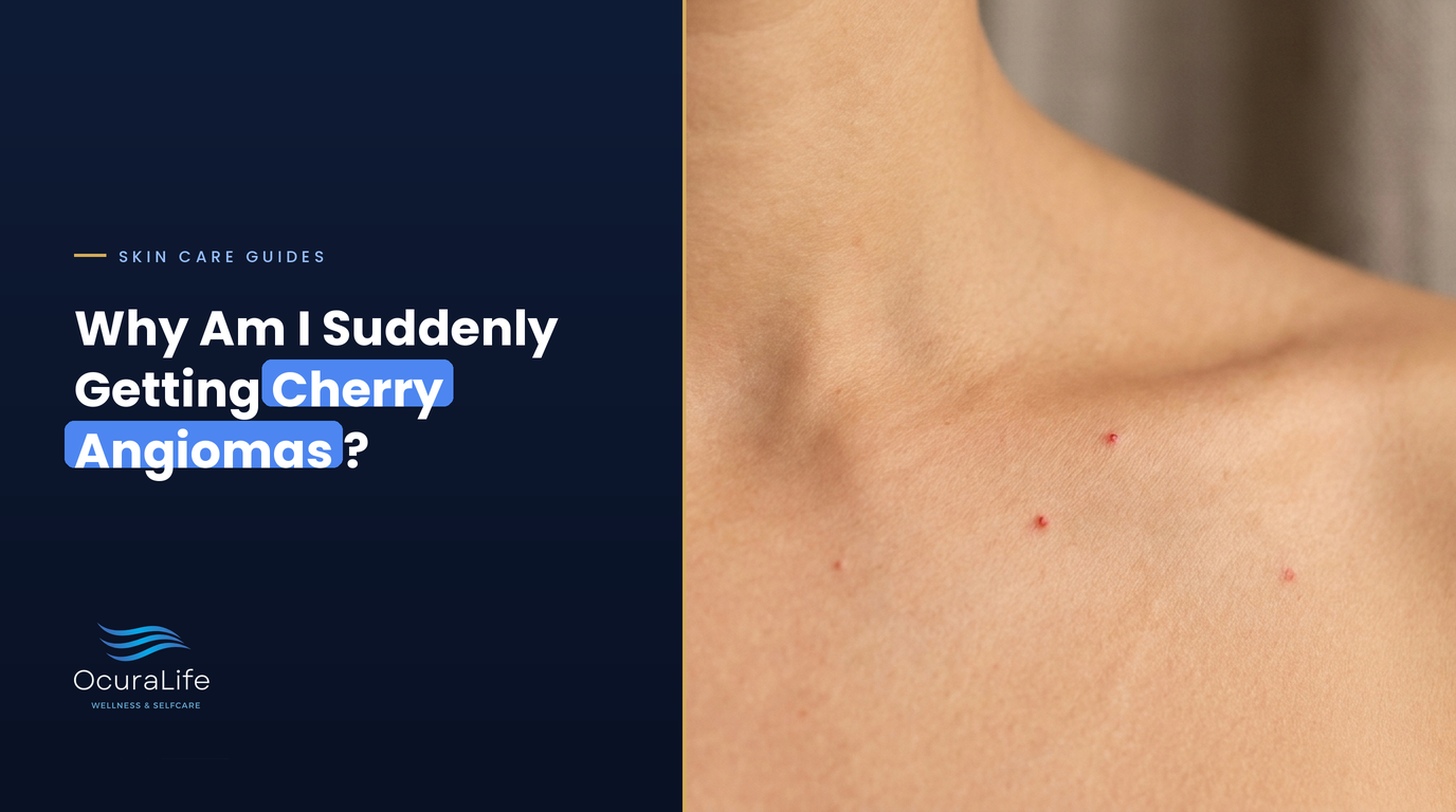 Why Am I Suddenly Getting Cherry Angiomas?