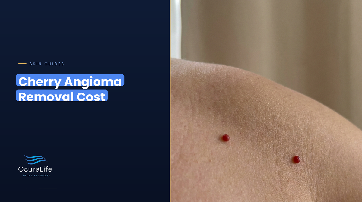 Two small bright red cherry angiomas on the skin of a shoulder, cherry angioma removal cost guide
