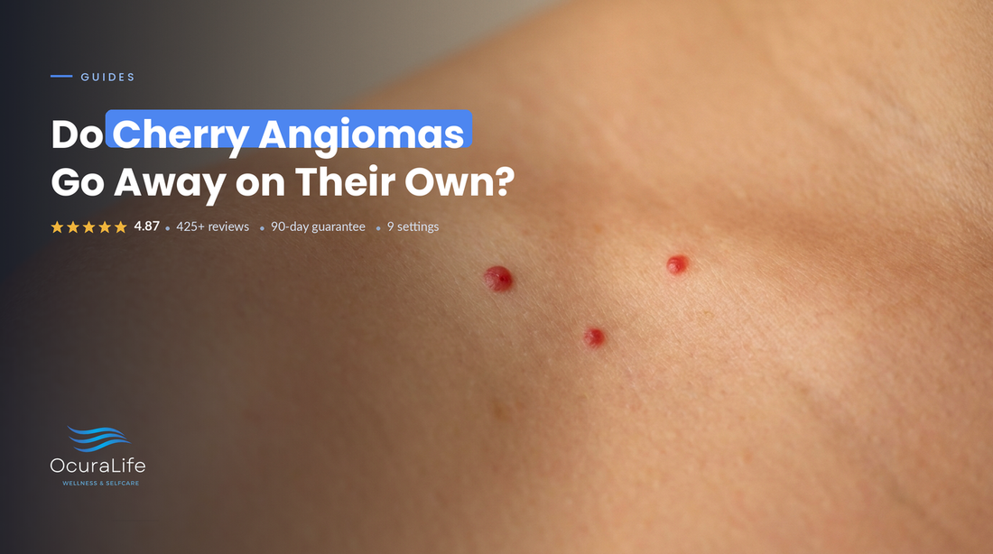Do Cherry Angiomas Go Away on Their Own?