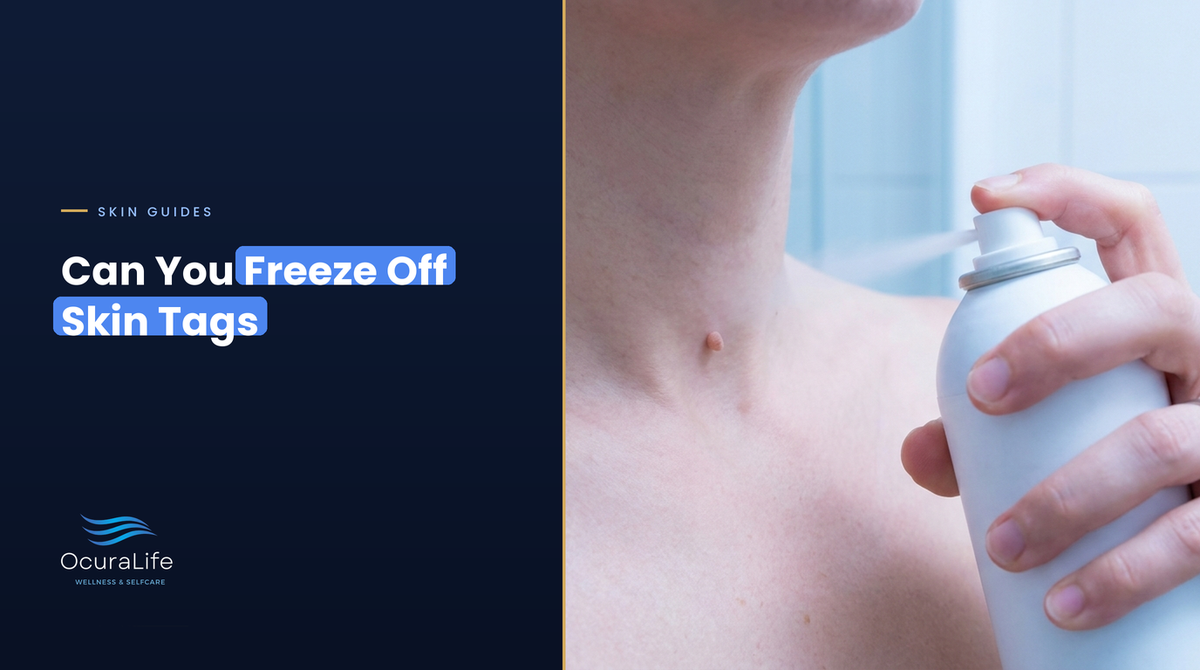 Woman holding an at-home freeze kit spray near a small skin tag on her neck
