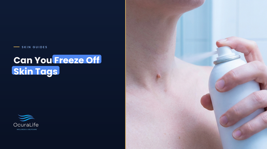 Woman holding an at-home freeze kit spray near a small skin tag on her neck
