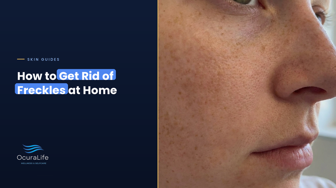 How to get rid of freckles at home: light brown freckles across a woman's cheek and nose