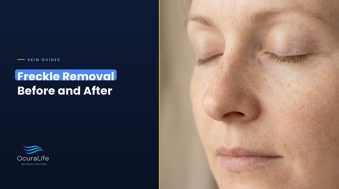 Freckle removal before and after: close-up of natural freckles on bare skin