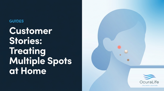 Customer Stories: Treating Multiple Spots at Home